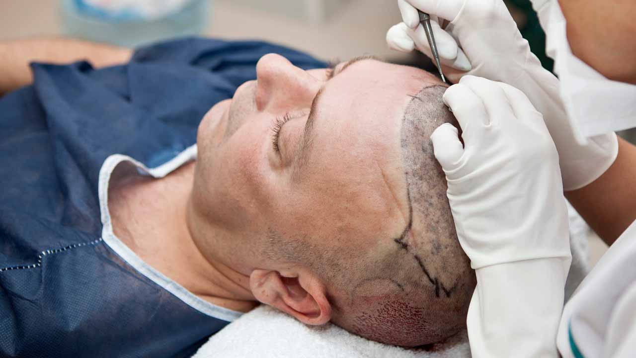 What is PRP Hair Restoration